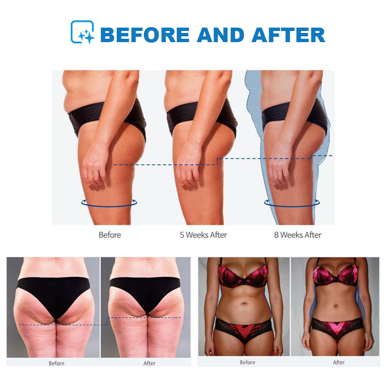 Electromagnetic 4 Handles emsl - đánh giá và giá Ems Body Sculpting Machine Emslim